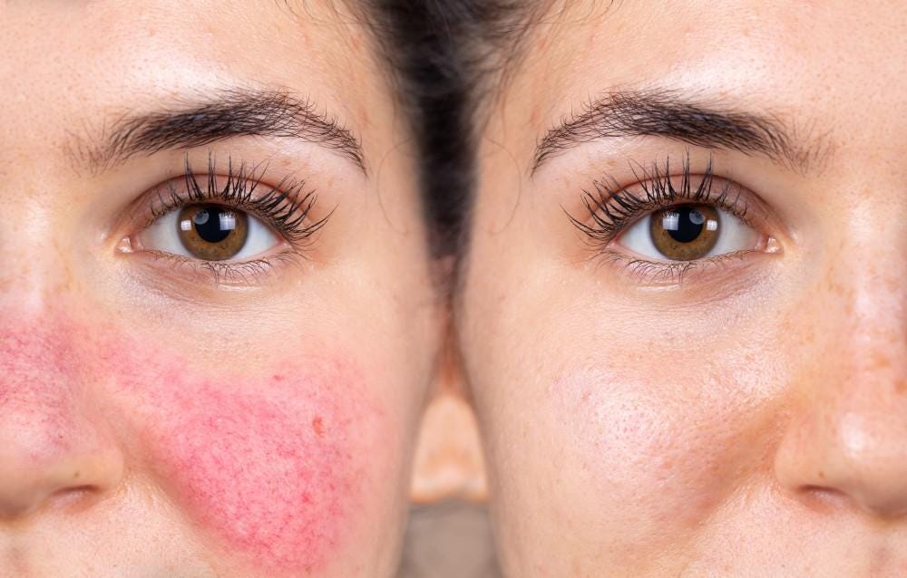 Preview image for What Makes Rosacea Flare Up Suddenly?