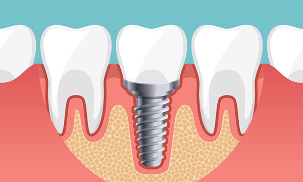 How Gums Grow and Bond to Dental Implant Teeth Explained by Jamaica