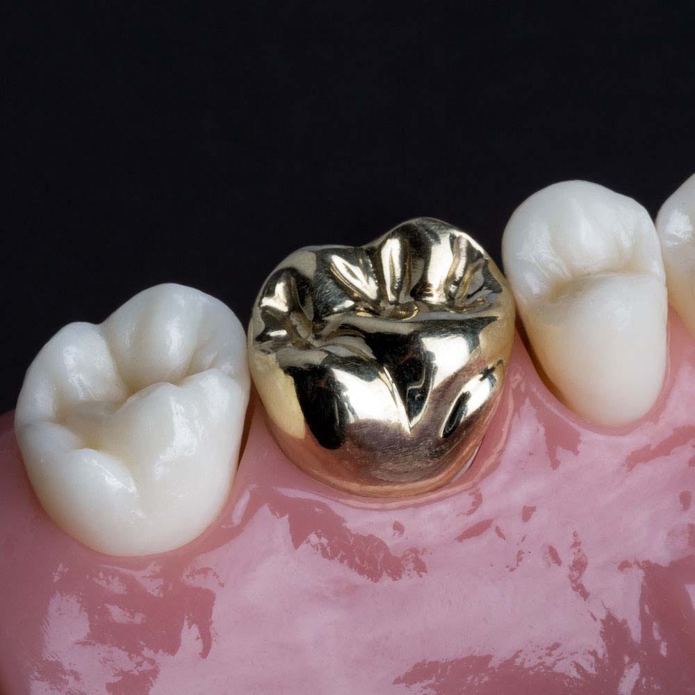 Features of Metal Ceramic Crown. Dental restorations made entirely of ...