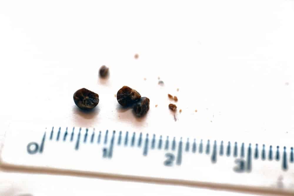 How Do You Treat The Different Sizes Of Kidney Stones Differently? by
