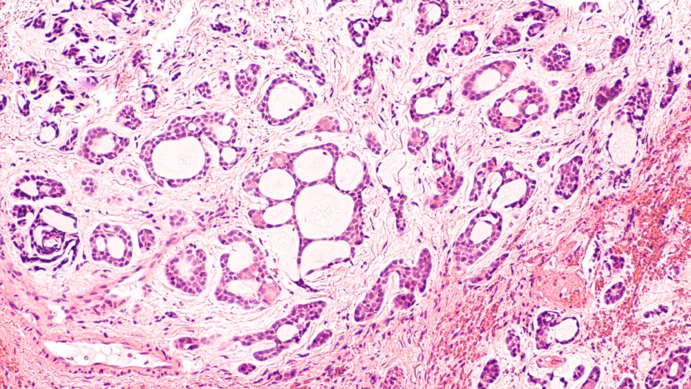 Treating Adenoid Cystic Carcinoma 