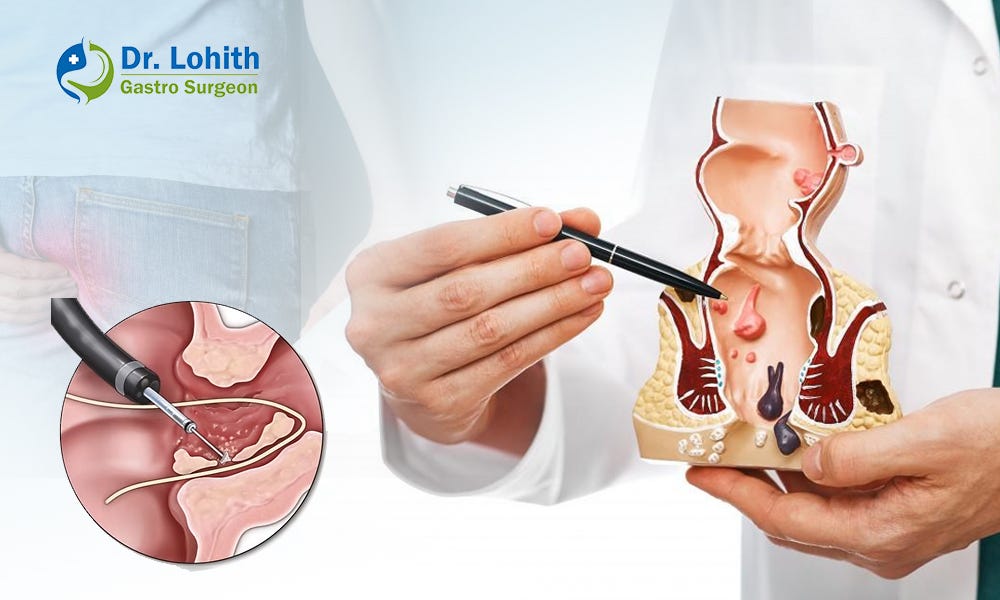 Fistula treatment in Bangalore