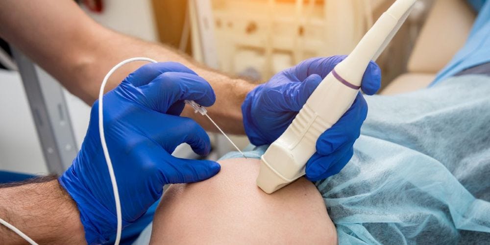 What Radiofrequency Ablation (RFA) Is and When It May Help