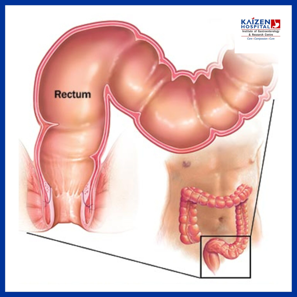 what-are-the-symptoms-of-a-serious-colon-problem-kaizen-hospital