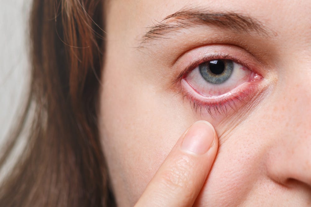 Effective Home Remedies for Eye Itching Relief — Bachulal by Bachulal