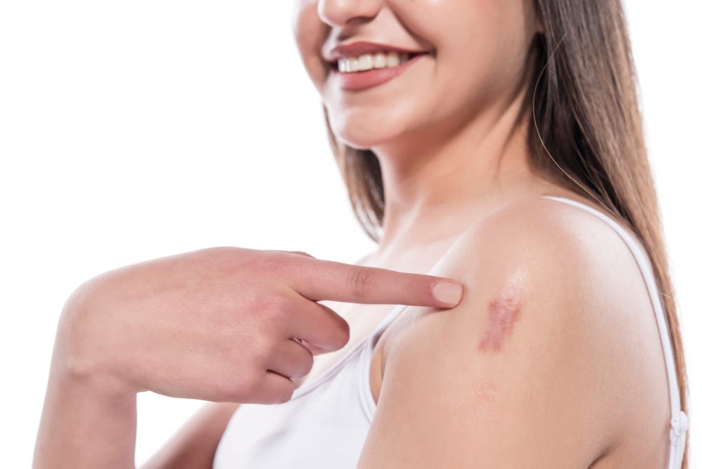 WHAT IS KELOID WHY IT HAPPENS?. Keloids are peculiar raised scars that… by InsideTunnel Oct