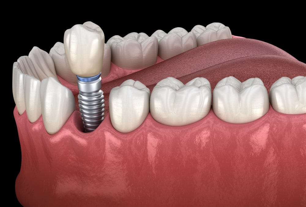 How to Easily Find Dental Implant Providers Using Your ZIP Code by