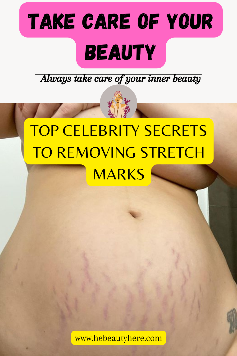 Stretch marks and how to get rid of them Why do they appear by laura