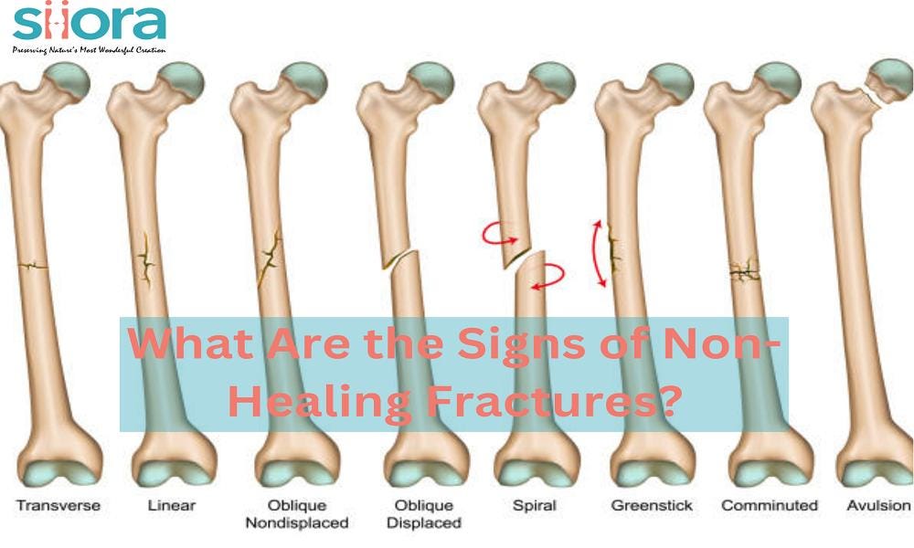What Are the Signs of NonHealing Fractures? Siora surgical Medium