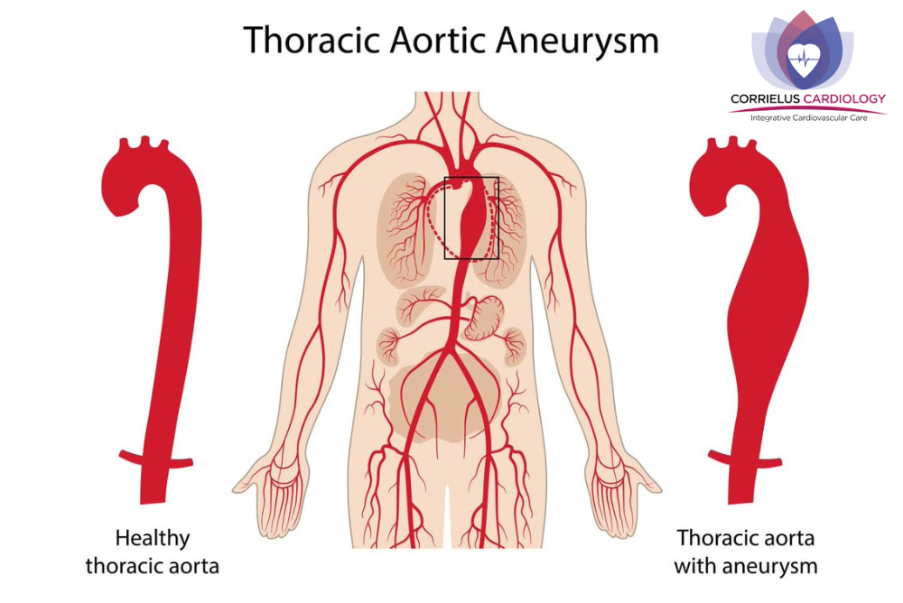 Can Aortic Aneurysms Be Life threatening By Corrielus Cardiology can-aortic-aneurysms-be-life-threatening-by-corrielus-cardiology