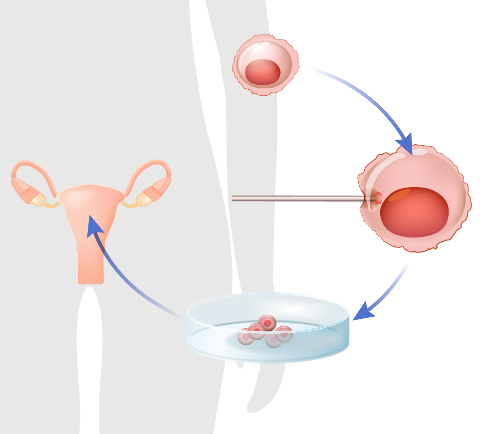What Are The Things Involved In Egg Donation Procedure? by Patriot
