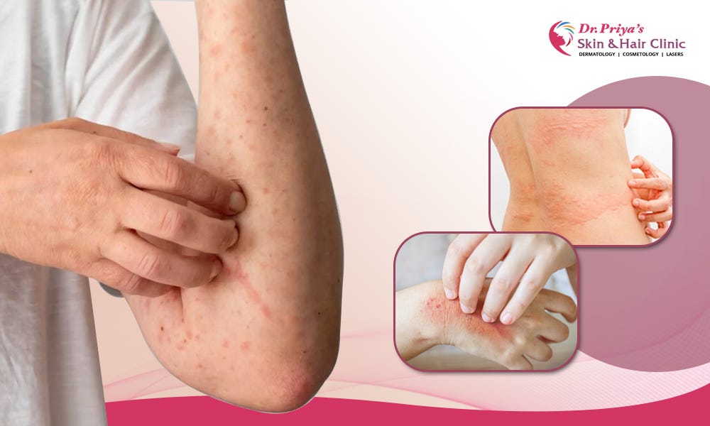 Managing Skin and Hair Common Allergies: Unveiling the Relief Strategies