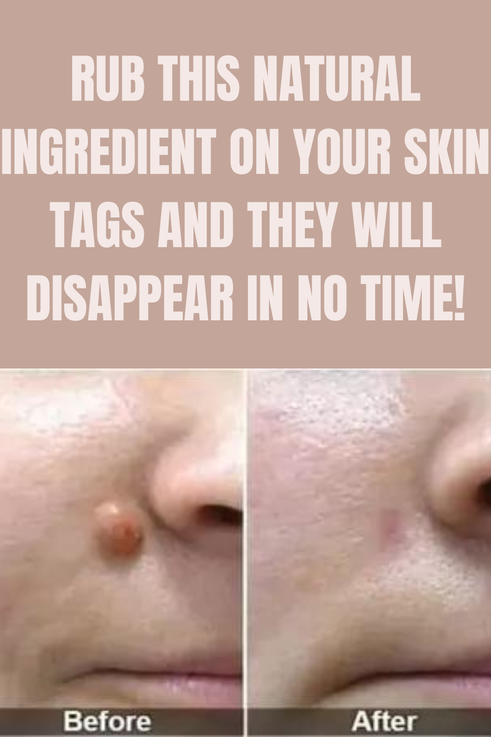Rub This Natural Ingredient on Your Skin Tags and They Will Disappear