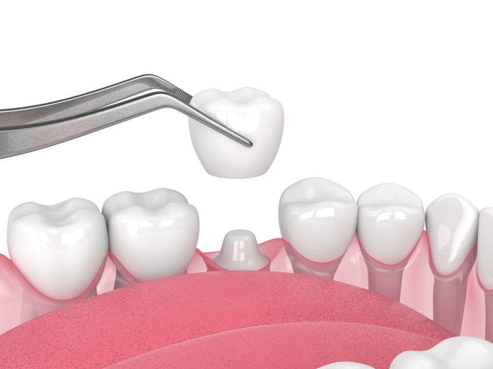 Managing Tooth Sensitivity Following a Crown Replacement Comprehensive