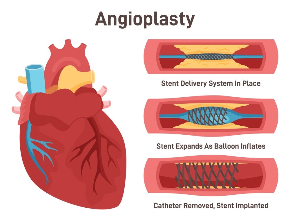 Angioplasty: Types, Procedures, Risks, and Recovery | by Raj Hospitals ...