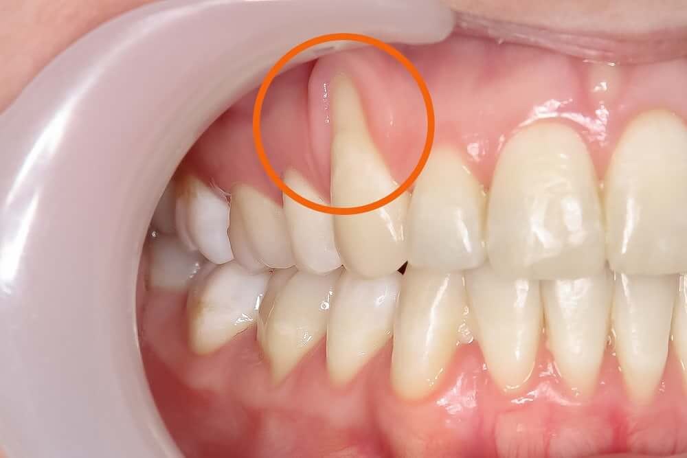 How To Reverse Receding Gums Reddit? by Geipowasuminr Medium