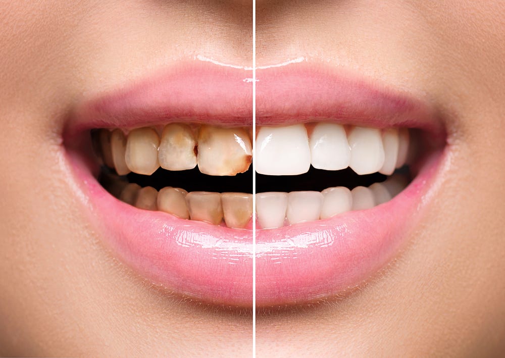 About Orthodontix Dental Clinic in Dubai UAE Scale and Polish Treatment |  by Dentalclinicdubai | Medium