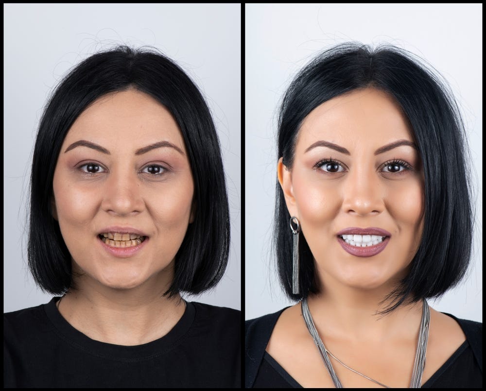 How to take care of your Dental Veneers to make them last longer. by