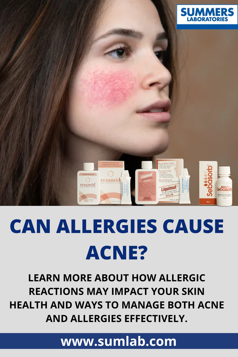 How do you get rid of acne from allergies? Summerslaboratories Medium