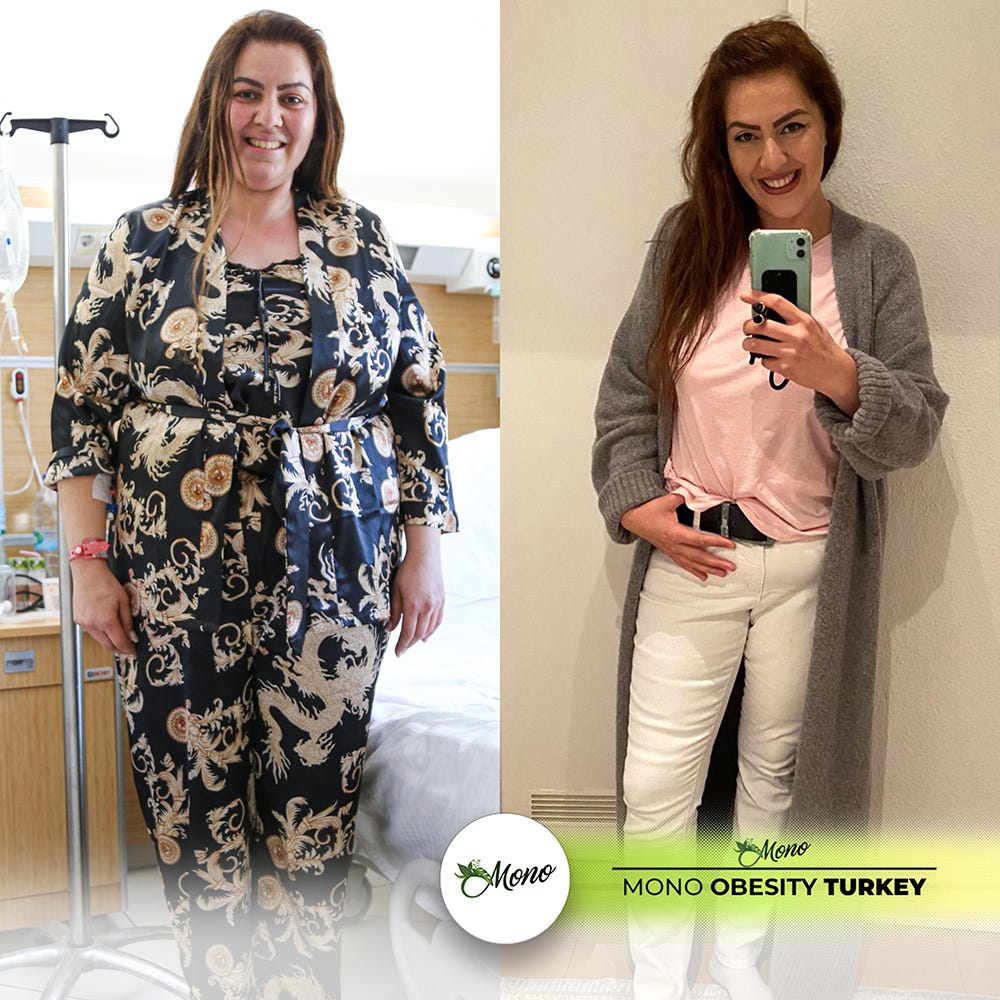 Gastric sleeve Turkey. Gastric Sleeve Turkey, Weight loss… by Aras