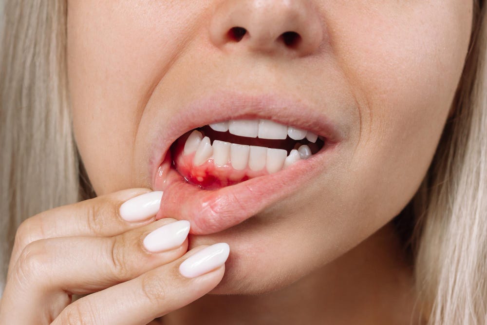 The Common Causes of Bleeding Gums | by Dentist Drummoyne | Feb, 2024