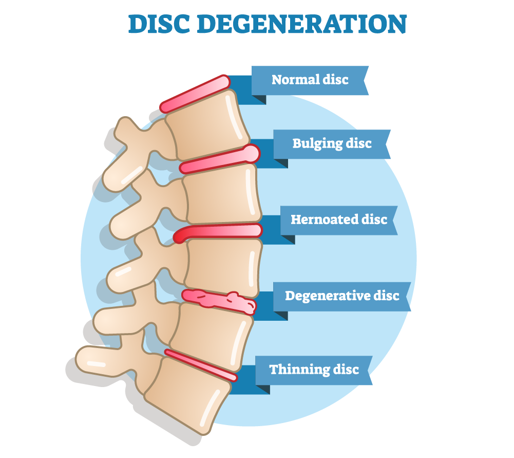 Recognizing Lumbar Disc Herniation: Indications, Signs, and Management | by  Anemona Abby | Medium