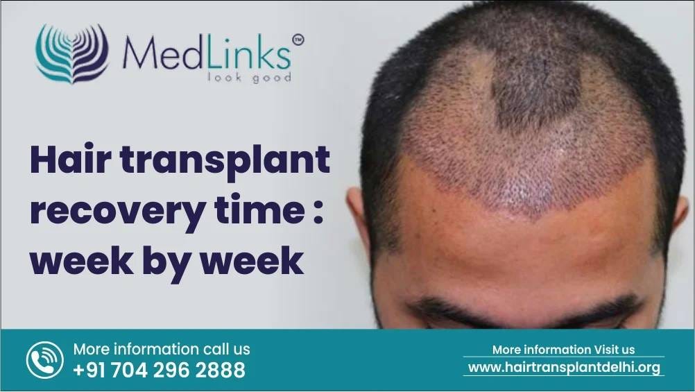 Hair Transplant Recovery Time Week by Week by Mohit Sharma Dec