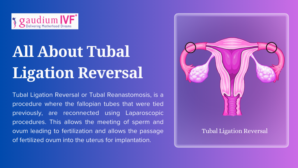 All About Tubal Ligation Reversal Gaudium IVF Medium