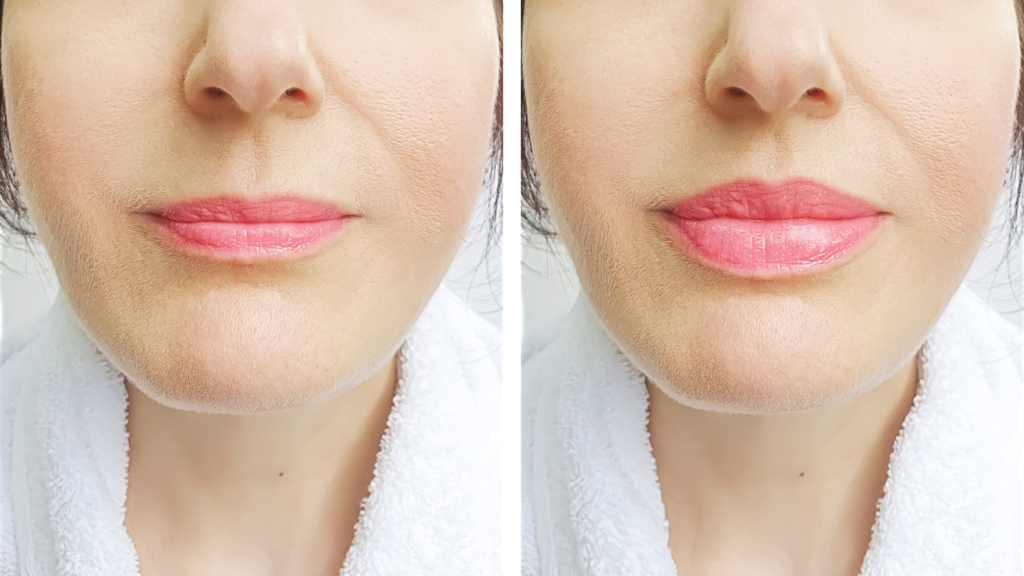 About Lip Surgery and Treatments