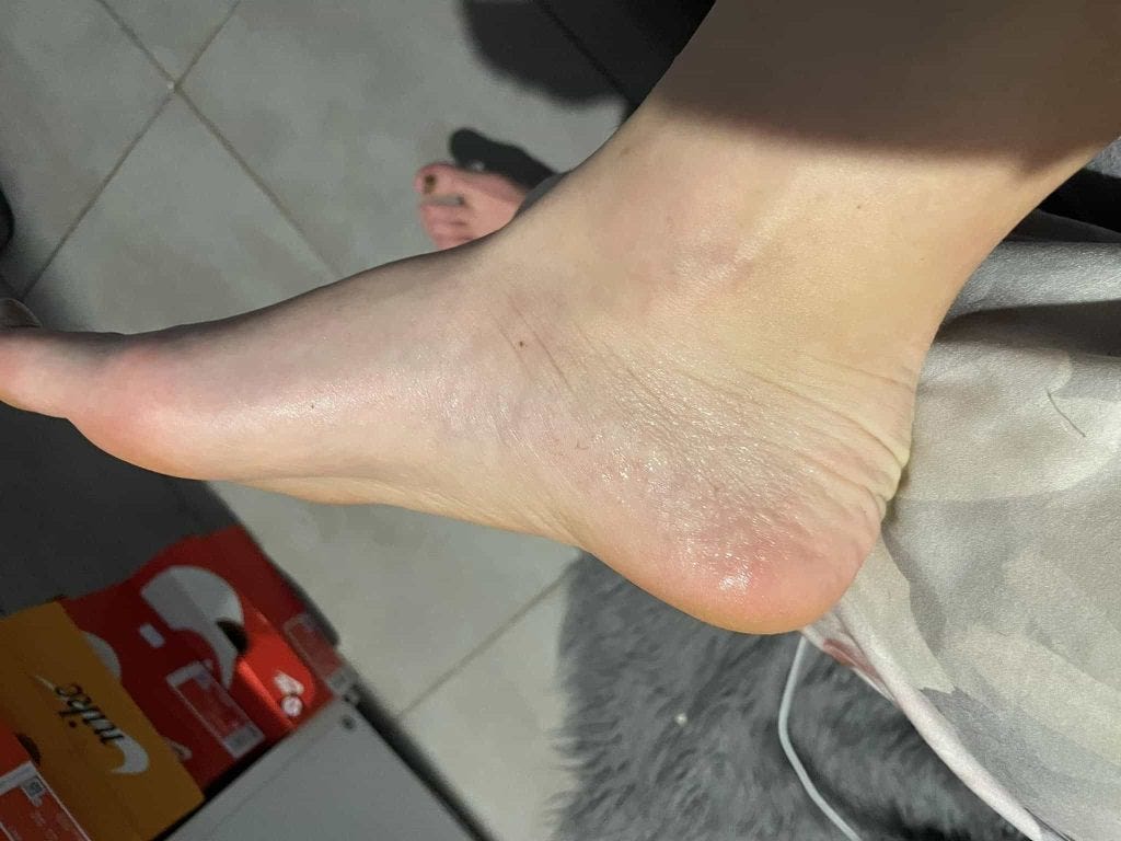 Why Are My Feet Cold But Sweaty? — 269 Free Shipping Iontophoresis