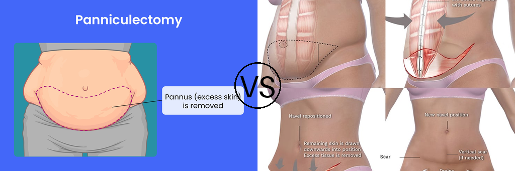 Panniculectomy vs Tummy Tuck: Which Procedure Suits You Best? | by Top