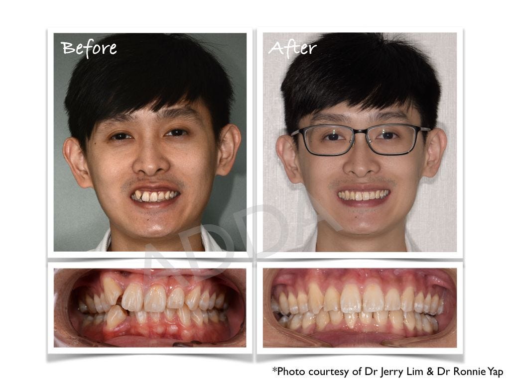 Invisalign Before and After Case Study 9, by Aesthetic and Digital  Dentistry Academy (ADDA)