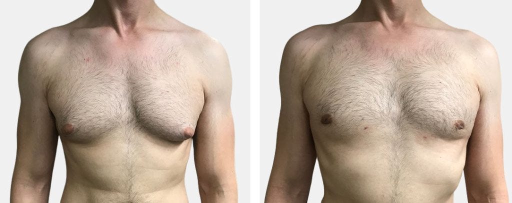 Understanding Gynecomastia: Causes, Symptoms, and Treatment Options, by  AESTHETIC & COSMETIC SURGEONS, Feb, 2024