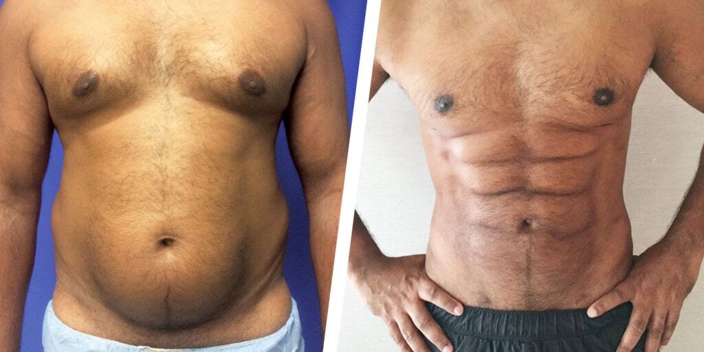 Six pack abs after hernia surgery by Topentise Medium