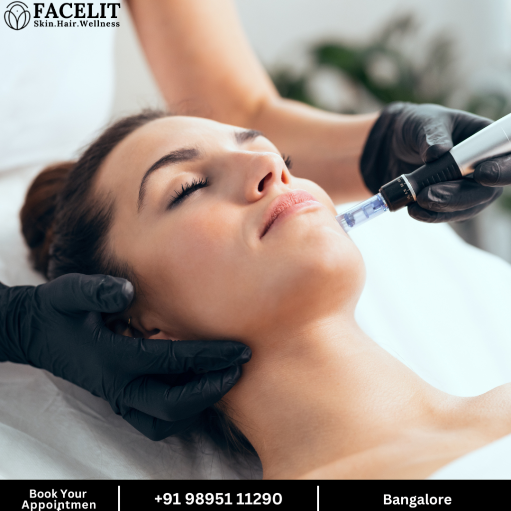 Microneedling with Dermapen for Fine Lines and Wrinkles in Bangalore