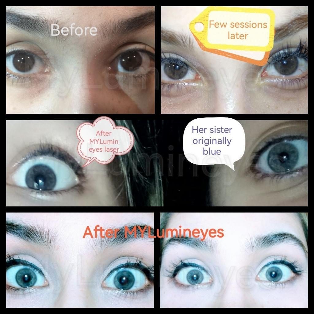 Eye color change surgery ways. Eye color change surgery ways by