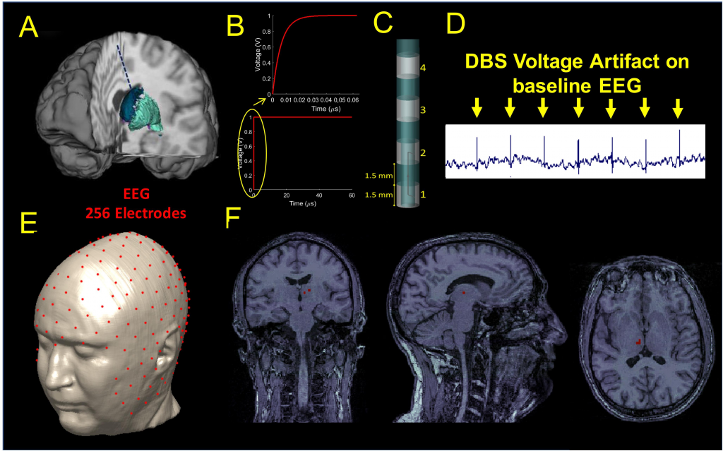 Physical simulation model for placement of deep brain stimulator