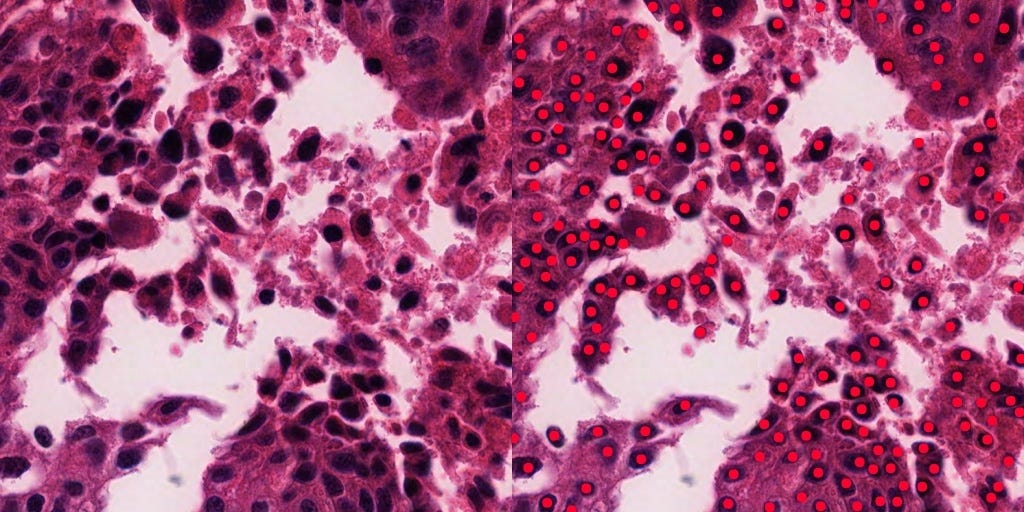 Cell patch annotations — typically, a very small area is annotated with cells, as even such tiny regions can contain hundreds of cells from diverse classes. Depicted in this example from TCGA LUSC, are tumor cells annotated as red dots.