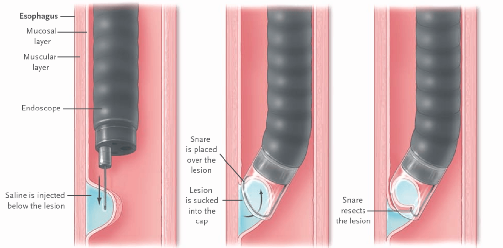 Endoscopic Mucosal Resection (EMR) Medigest Medium