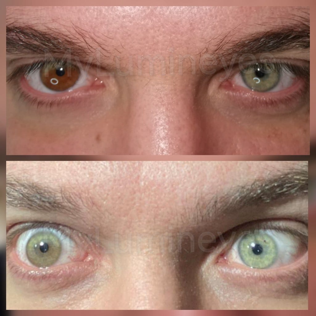 How to Naturally Change Your Eye Color? Laser Or Surgery ?, by Mylumineyes