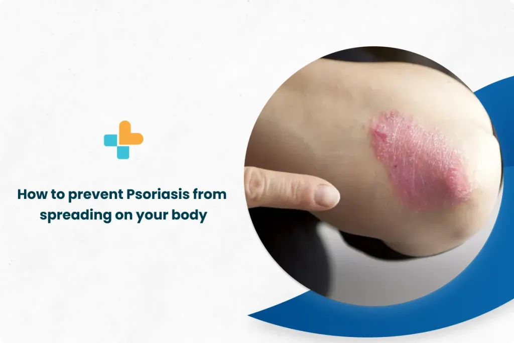 How to Prevent Psoriasis From Spreading On Your Body by Ayu Health Hospitals Medium
