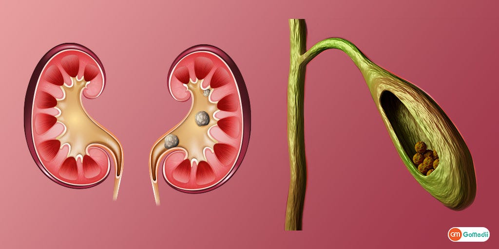 What’s the difference between Gallbladder Stones & Kidney Stones? by
