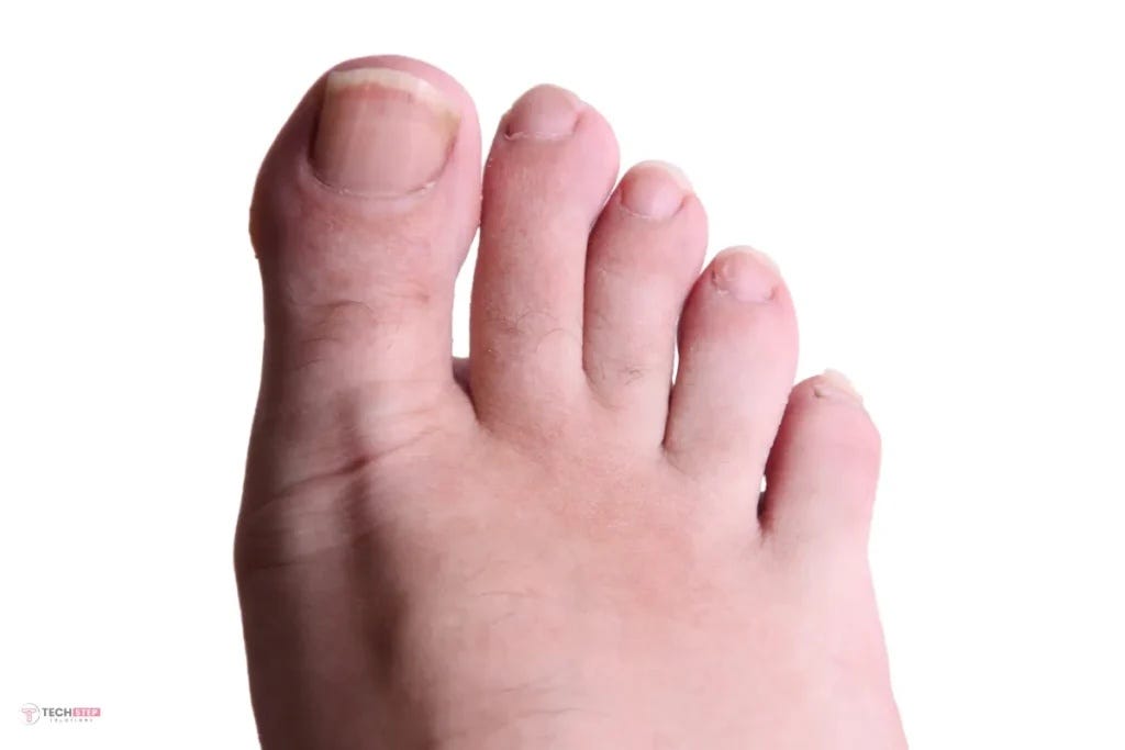 Laser Toenail Fungus Treatment in Irvine: A Modern Solution for Healthier Nails