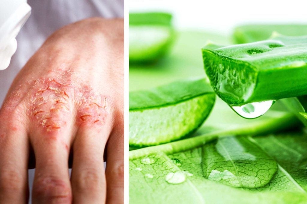 Eczema Naturally TreatsAloe Vera 6 Powerful Steps. by PRADIP JAYDHAR