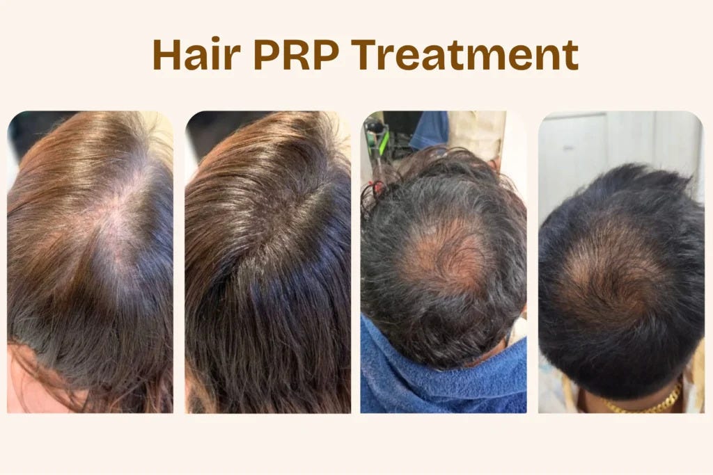Hair PRP Treatment in Borivali: Benefits, Procedure & What to Expect