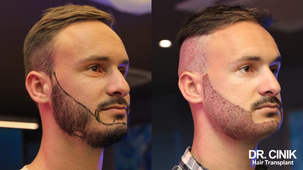 NonSurgical Beard Growth Alternatives The Pros and Cons by Bewfalog