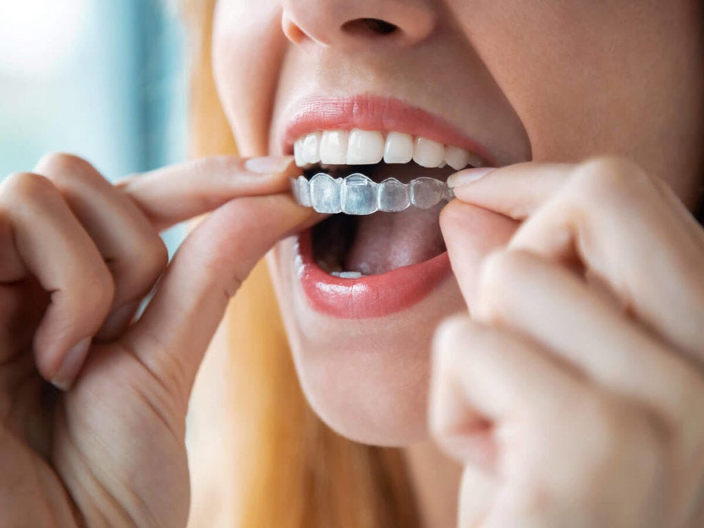 Clear Aligners Success How to Recognize If Your Treatment Is on Track in Dubai by