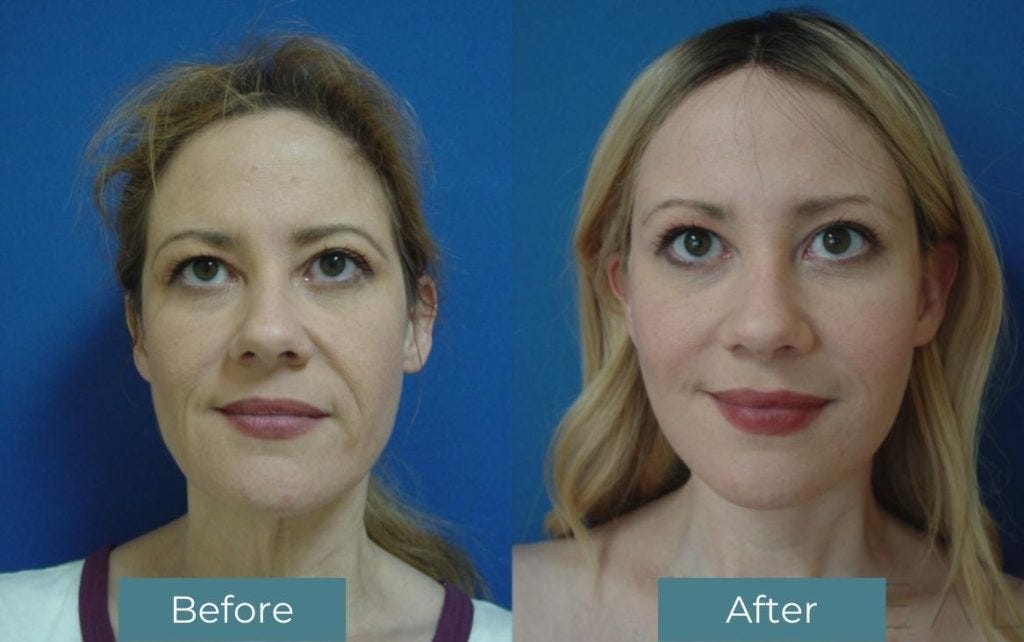 Facelift Turkey  Rhytidectomy Surgery Cost 2024