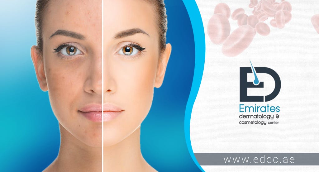 Revive your Natural Beauty with PRP Treatments Abu Dhabi by hellen m