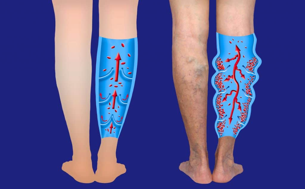 Chronic Venous Insufficiency: Causes, Symptoms, and Treatment
